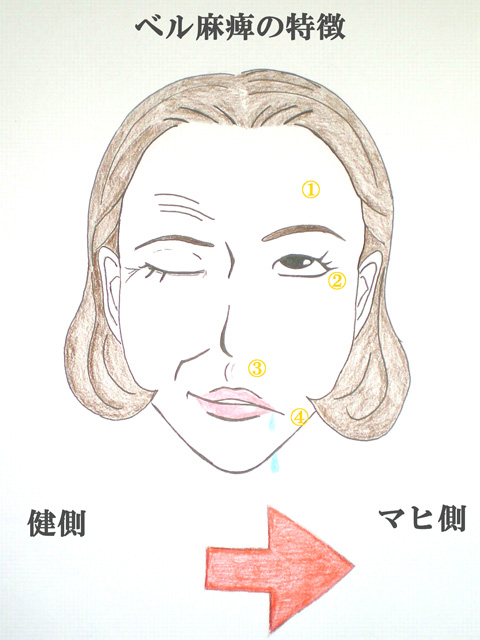 顔面神経痛ベル麻痺